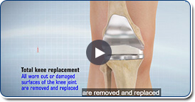 Uni Knee Replacement