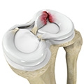 Study suggests surgery better than observation for older patients with meniscus tear