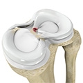 Surgery better than observation for older patients with meniscal root tear, study suggests