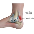 What Causes Tendon Inflammation?