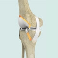 Young athletes who require ACL reconstruction may benefit from additional procedure
