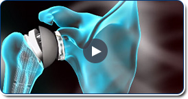 Arthroscopic Biological Total Shoulder Resurfacing