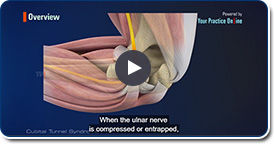 Cubital Tunnel Syndrome