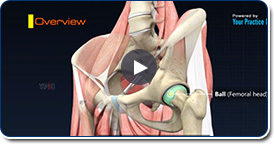 Femoro Acetabular Impingement