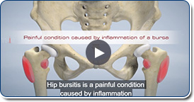 Hip Bursitis