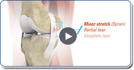 Medial Collateral Reconstruction