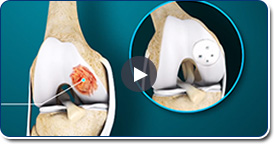 Osteochondral Allograft