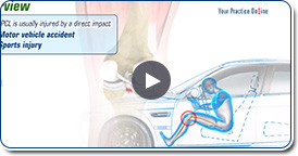 Posterior Cruciate Reconstruction