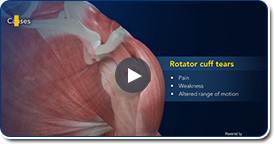 Rotator Cuff Tear