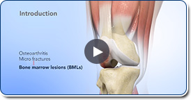 Subchondroplasty