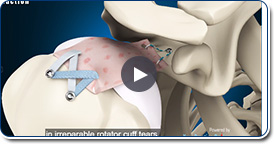 Superior Capsule Reconstruction