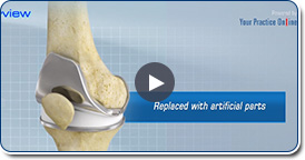 Total Knee Replacement