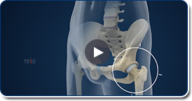 X-ray Guided Hip Injection